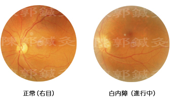 白内障症例2