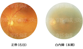 白内障症例3