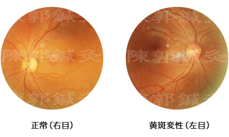 黄斑変性症例