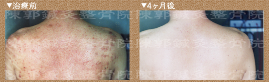 アトピー性皮膚炎 治療例